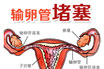 COOK导丝微创介入术---开启孕育之门